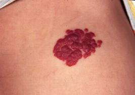 hemangioma