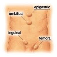 hernias