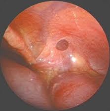 hernia defect.