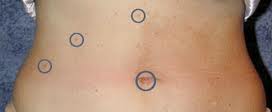 lap chole incisions
