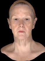 sagging face