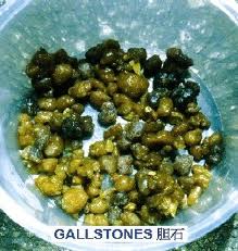 gallstones