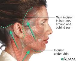 face lifting