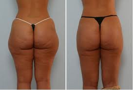 liposuction