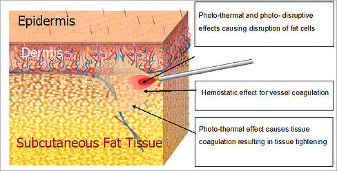 Laser Effect of Treated Are