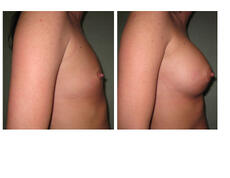 breast augmentation