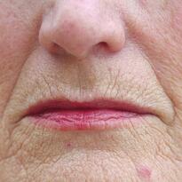 lip wrinkles
