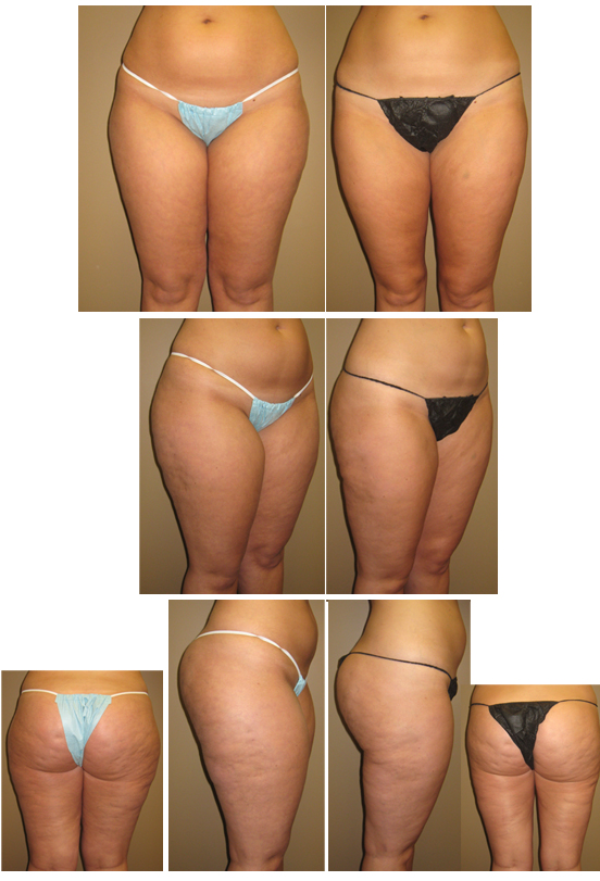 lipo