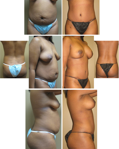 tummy tuck hip lipo