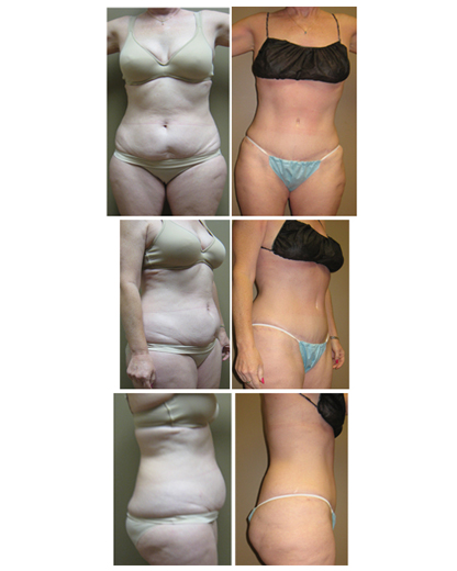tummy tuck, lipo hips