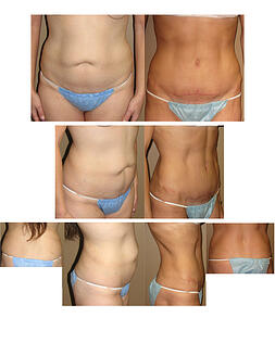 Tummy tuck, lipo