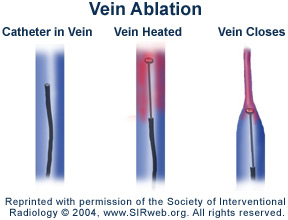 laser closure