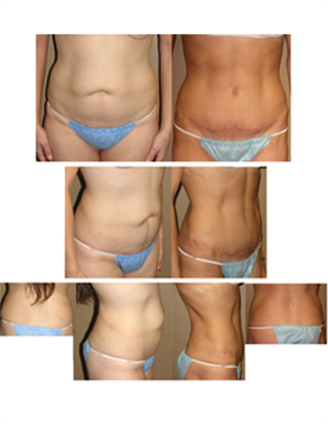Full tummy tuck with hip lipo
