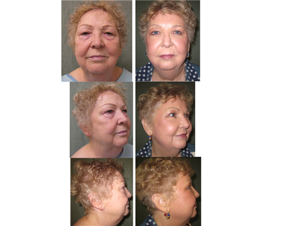 Upper and lower eyelid surgery with full face laser