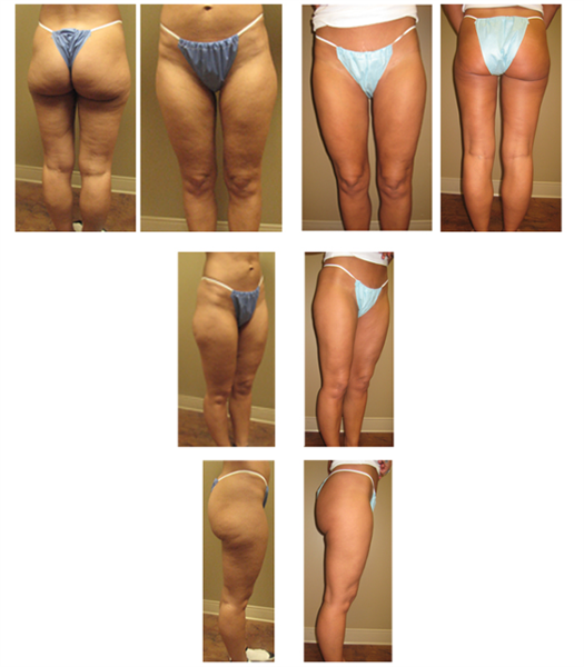 leg liposuction, inner and outer thighs.