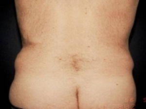 lipo suction love handles pic46 before