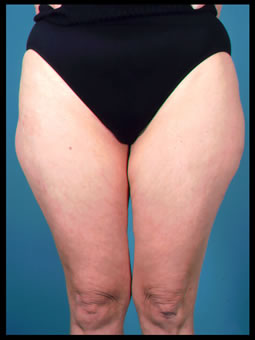 fatty thighs