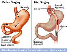 gastric bypass
