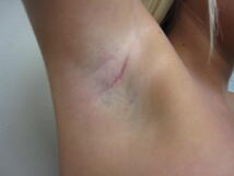 transaxillary incision