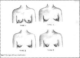 tubular breasts