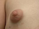 herniated "puffy" nipple