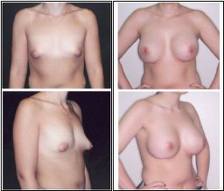 tubular breast repair