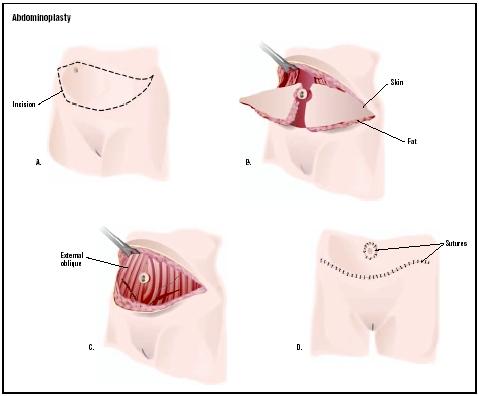 tummy tuck