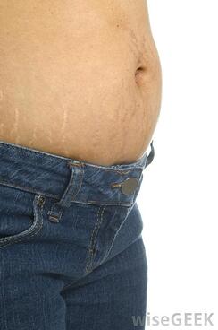 abdomen stretchmarks