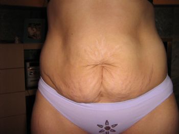 stretch marks