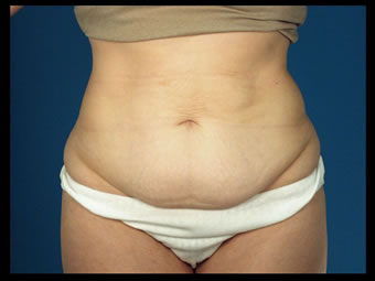 lower abdominal apron