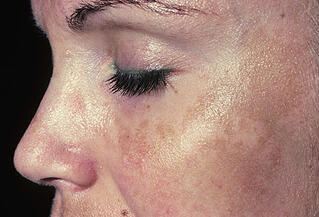 melasma