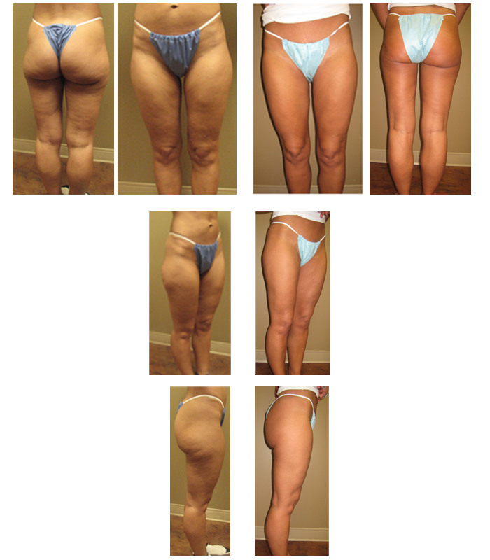 leg liposuction