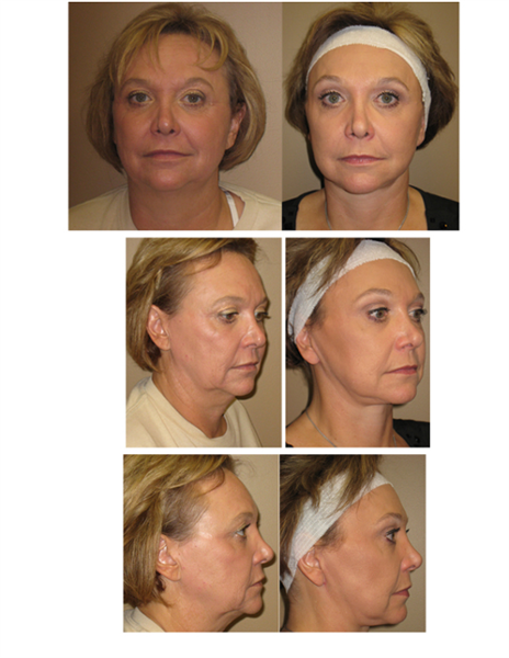 endoscopic forehead and brow lift with lower face and neck lift
