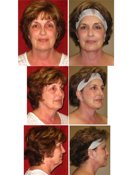 lower face and neck lift with lower eyelid surgery and facial fat grafting
