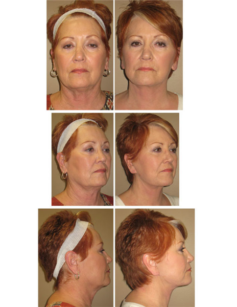 lower face and neck lift