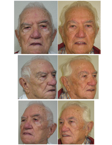 lower eyelids with canthopexy