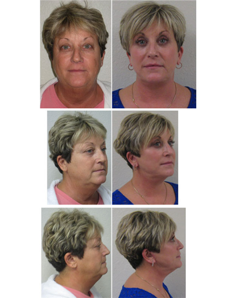 lower face and neck lift with upper and lower eyelids