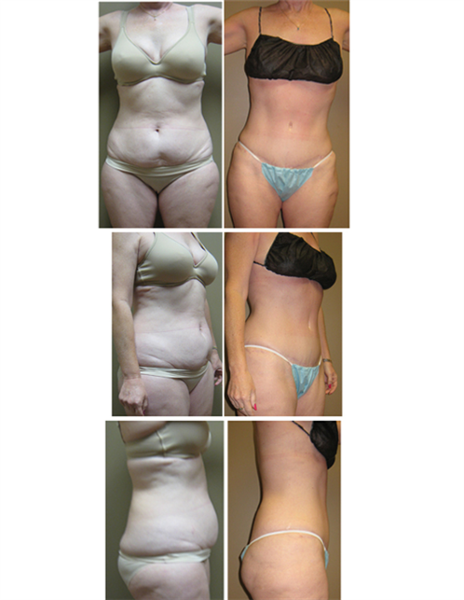 full tummy tuck with hip liposuction
