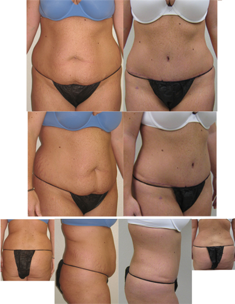 full tummy tuck with hip liposuction