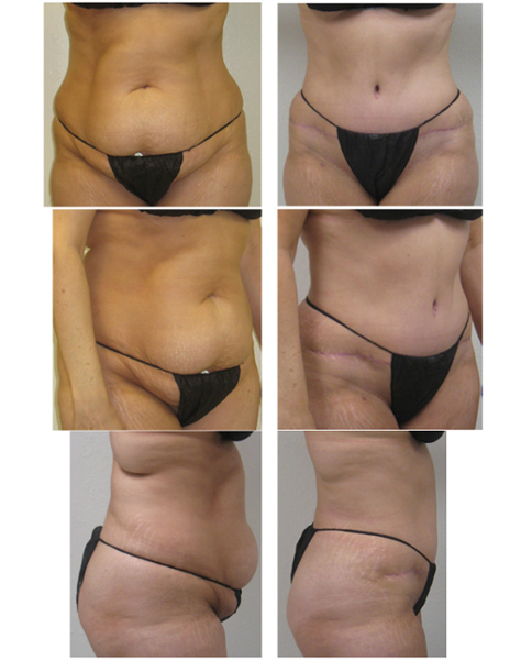 full tummy tuck