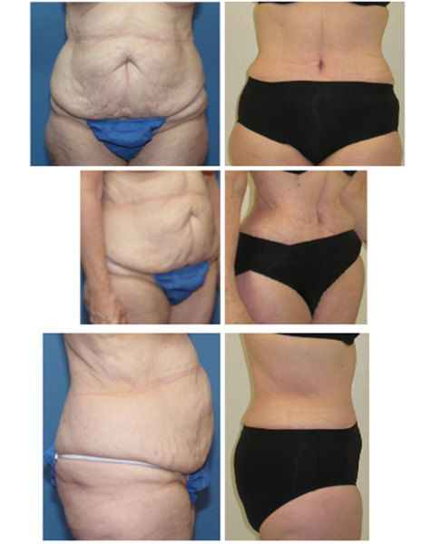 full tummy tuck with hip liposuction