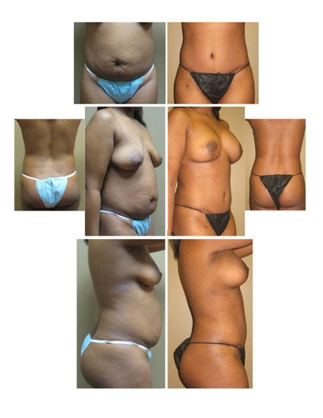 full tummy tuck and hip liposuction