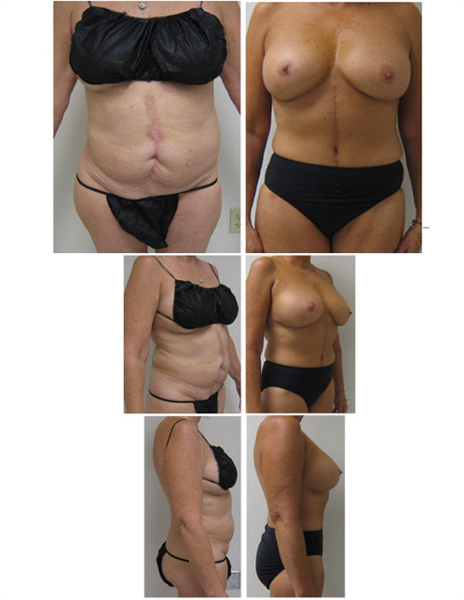 full tummy tuck with liposuction