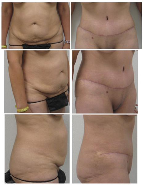 full tummy tuck