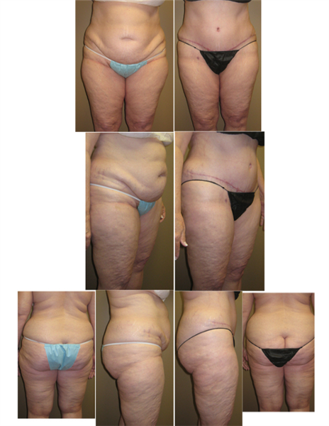 full tummy tuck
