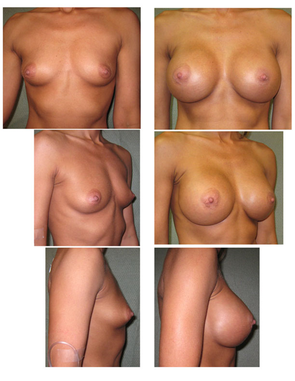 saline implants, infra-mammary approach
