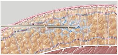 liposuction infiltration