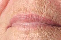 lip lines