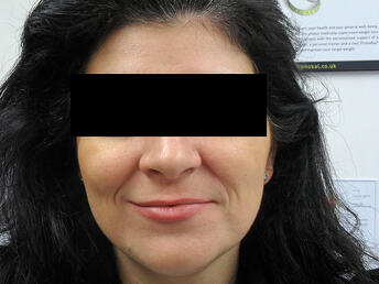nasolabial folds