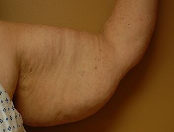 fat arms